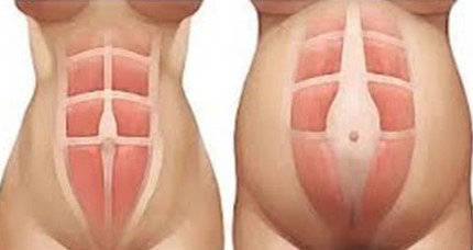 ابدومینوپلاستی و فواید استفاده از گن بعد از آن